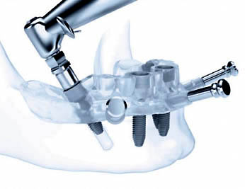 cirugía minimamente invasiva dental en granada