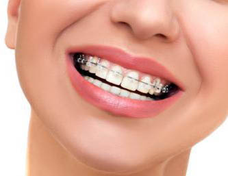 imagen del tratamiento de ortodoncia 